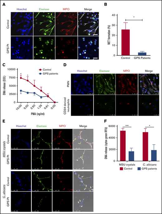 Impaired NETosis by GPS neutrophils and MPB CD34+HSC-derived neutrophils. (A) Neutrophils derived from blood from controls (upper panel) and patients with GPS (lower panel) were stimulated with PMA (100 ng/mL) for 3 hours, and NET formation was visualized by staining for DNA (blue), elastase (green), and MPO (red). Scale bars, 20 µm. (B) NET formation was determined by counting the number of NETs per field of 100 cells in control and GPS neutrophils, stimulated with PMA (100 ng/mL) for 3 hours, in ≥5 fields. (C) DNA release was measured in the supernatant from control and GPS neutrophils stimulated with increasing concentrations of PMA (n = 3-5). (D) Control neutrophils from blood (PMN, upper panel) or MPB CD34+ HSC-derived neutrophils (lower panel) were stimulated with PMA (100 ng/mL) for 3 hours, and NET formation was visualized by staining for DNA (Hoechst, blue), elastase (green), and MPO (red). Shown are representative images of n = 3. Scale bars, 50 µm. (E) Neutrophils derived from blood from controls and patients with GPS were stimulated with MSU crystals (200 μg/mL, upper panel) or opsonized C albicans (lower panel) for 4 hours. NET formation was visualized by staining for DNA (blue), elastase (green), and MPO (red). White arrows in the merge images indicate the MSU crystals (upper panel) or the C albicans hyphae (lower panel). Scale bars, 100 µm. Shown are representative images of n = 3-9. Pt, patient. (F) DNA release was measured in the supernatant from control (n = 7-9) and GPS (n = 3-4) neutrophils stimulated with MSU crystals (200 μg/mL) or opsonized C albicans for 4 hours. RFU, relative fluorescence units. Results are means ± SEM. An unpaired, 2-tailed t test was used. *P < .05, ***P < .001 compared with control neutrophils.