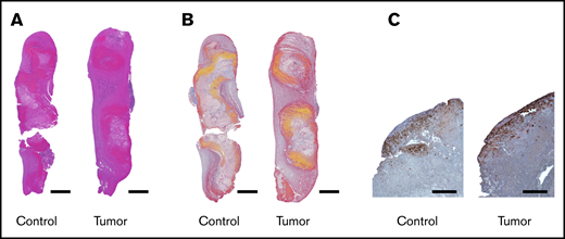 Characterization of thrombi from control and tumor-bearing mice. Thrombi were embedded in paraffin, sectioned longitudinally, and stained with hematoxylin and eosin (A) or Martius Scarlet Blue (B). With hematoxylin and eosin, red blood cell areas are red, platelet areas are pink, and inflammatory cell areas are purple. With Martius Scarlet Blue staining, red blood cell areas are yellow, platelet areas are gray, and fibrin areas are red. Representative pictures from 5 thrombi from controls and 6 thrombi from PANC-1 tumor-bearing mice. Scale bars, 700 µm. (C) Macrophages in thrombi from control and tumor-bearing mice were stained with an anti-Iba-1 antibody. Scale bars, 200 µm.