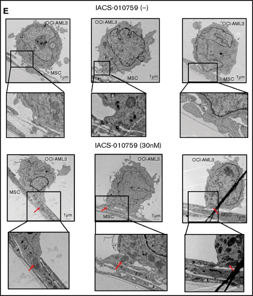 Mitochondrial transfer from MSCs to AML cells is induced by OxPhos inhibition. (A) OCI -AML3 and MOLM13 cells were stably transfected with mitochondria-targeted PDHA1-GFP, and MSCs were transfected with PDHA1-dsRed (upper left panel). Confocal microscopy images at ×40 magnification. Representative confocal images of dual fluorescence (GFP and dsRed)–positive OCI-AML3 cells cocultured with MSCs in the presence of 30 nM IACS-010759 for 72 hours (lower left panel; yellow arrow: GFP and dsRed dual-positive cell). To quantitatively determine the rate of mitochondrial transfer, OCI-AML3 cells cocultured with MSCs were separated from the MSC monolayer by careful pipetting, and the GFP and dsRed dual-positive recipient cells per 100 GFP+ cells (n > 5) were counted at ×40 magnification by live-cell imaging with confocal microscopy (right panel). Laser scanning was used to obtain images under a confocal microscope. (B) To compare direct-contact to noncontact conditions, OCI-AML cells were cocultured with PDHA1-dsRed–transfected MSCs in direct contact or separated by a transwell insert and treated with IACS-010759 (30 nM) for 72 hours. OCI-AML3 cells cultured in direct-contact conditions were separated from the MSC monolayer by careful pipetting. dsRed-positive OCI-AML3 cells per 100 OCI-AML3 cells (n > 5) were counted at ×40 magnification by live-cell imaging with confocal microscopy. (C) PDHA1-GFP–transfected OCI-AML3 cells were treated with the OxPhosi IACS-010759 (30 nM) for 72 hours in the presence or absence of PDHA1-dsRed transfected MSCs. The rate of MSC-derived mitochondrial transfer in OCI-AML3 cells that adhered to MSCs was determined by flow cytometric analysis after depletion of MSCs with MACS as described in supplemental Materials and Methods. Representative flow cytometry plots are shown on the right . (D) Representative confocal microscopy images show the formation of TNTs and protrusion formation in OCI-AML3 cells after treatment with IACS-010759 under MSC coculture conditions. The red arrows indicate the transfer of MSC-derived mitochondria along TNTs. Confocal microscopy images at ×63 magnification. (E) OCI-AML3 cells were treated with the OxPhosi IACS-010759 (30 nM) for 48 hours in the presence of MSCs. Representative electron microscopy images show the IACS-010759–treated OCI-AML3 cells migrating to cocultured MSCs with mitochondrial transport to the leading edge of a protrusion, which was not observed in untreated (control) cells. Red arrows indicate mitochondria. Error bars in the graphs show the means ± SDs of the results from 3 independent experiments. **P < .01. SSC, side scatter.