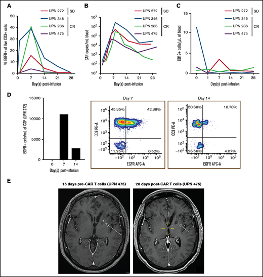 Percentages of CAR T cells in the blood and CSF. (A) Persistence of EGFR+ CAR T cells in blood circulation of patients after CAR T-cell infusion on days 0, 1, 7, 14, 21, and 28. The percentage of EGFR+ T cells are gated from live CD3+ cells. (B) Expansion and persistence of CD19CAR T cells in blood of patients, as measured by Woodchuck post-transcriptional regulatory element (WPRE) copy number per milliliter of blood. (C) Levels of CD19+ cells in blood circulation after CAR T-cell infusion. CD19+ cells are gated from live cells. (D) Persistence of EGFR+ CAR T cells in CSF from unique patient number (UPN) 272 on day 0 and on days 7 and 14 post–T-cell infusion. Absolute cells per milliliter of CSF (left panel) and flow cytometry plots of CD3+ cell and EGFR+ cells on day 7 (middle panel) and on day 14 (right panel) post–CAR T-cell infusion. (E) Brain MRI series of UPN 475 pre–CAR T-cell infusion (left panel) and post–CAR T-cell infusion (right panel). Images are T1 weighted postcontrast axial. The pretherapy scan shows an enhancing lesion in the left basal ganglia (arrow) that is no longer present at 28 days post–CAR T-cell infusion. SD, stable disease.