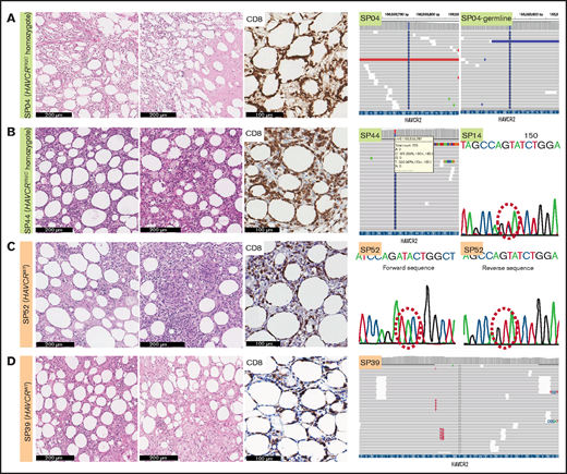 Histopathological features of SPTCLs and detection of HAVCR2Y82C mutations. (A) Excisional biopsy specimen of a 16-year-old female patient with an SPTCL (SP04) exhibited adipocytic rimming by CD8-positive lymphocytes along with prominent necrosis. This patient was confirmed by using WES to have a germline homozygous HAVCR2Y82C mutation. (B) Lipogranulomatous inflammation was observed in a 54-year-old female patient (SP44), and TGS revealed heterozygous HAVCR2Y82C mutations. SP14 harbored heterozygous HAVCR2Y82C mutations, which could be inferred from double peaks on the electropherogram. (C) A 45-year-old female patient (SP52) with the HAVCR2WT genotype had both necrosis and granuloma formation. (D) Lipogranulomatous inflammation was observed in the HAVCR2WT SPTCL of a 53-year-old woman (SP39).