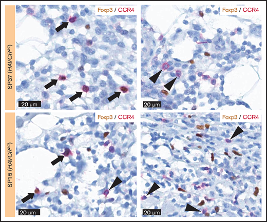 Double-staining for Foxp3 and CCR4. Double-staining showed the cells coexpressing Foxp3 and CCR4 (arrow) as well as the cells only positive for CCR4 (arrowhead), suggesting the presence of non-Treg CCR4-positive cells within the tumor microenvironment of SPTCL.