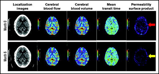 Representative cerebral CT perfusion imaging of a patient. Representative imaging slices of the cerebral CT perfusion scans of a patient. Images include the localization images, cerebral blood flow slices, cerebral blood volume slices, minute transit time images, and PS product images at the time of remission and 6 months later. Of note, images of a normal brain would have minimal contrast leakage through the BBB (ie, minimal blue color). The red arrow indicates diffuse BBB leakage at month 0 (1.26 ml/min/100 g) with modest improvement at month 6 (0.96 ml/min/100 g), shown with yellow arrow. Please see supplemental Figure 1 for comparison of PS product images of diffuse BBB leakage in a patient with TTP, localized BBB leakage in a stroke patient, and minimal BBB leakage in another stroke patient.