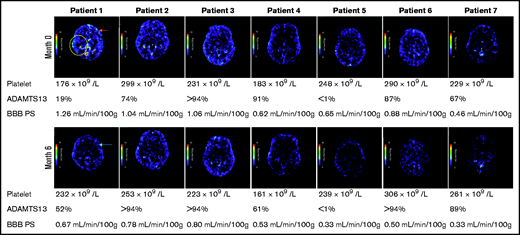 BBB PS map of all 7 patients at months 0 and 6. The yellow circle represents highest BBB PS product region in the 7 patients with iTTP (1.80 ml/min/100 g, at right parietal lobe). There is intense blue color in that region. For the same patient, the red and blue arrows represent a significant change between month 0 and 6 PS products (1.72-0.73 ml/min/100 g at the left frontal lobe). Please see supplemental Figure 1 for comparison of PS product images. Patient 4 had chronic ischemic changes on the CT images. Patient 5 had persistent low ADAMTS13 activities < 1% with inhibitor level > 94 U/mL, consistent with iTTP.