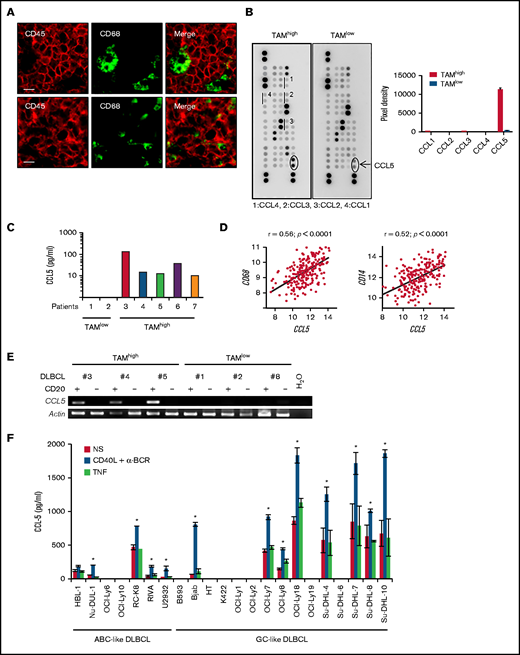 CCL5 expression in DLBCL correlates with TAM. (A) Tonsil (upper panels) and DLBCL biopsies (lower panels) were stained for CD68 and CD45. The photographs are representative of ≥10 tonsils and 10 DLBCLs. Scale bars, 10 µm. (B) Lysates of 2 DLBCL biopsies were profiled for chemokine expression (left panels). Duplicate dots corresponding to CCL5 are shown. Dots corresponding to other monocyte-acting chemokines are underlined. A quantification by pixel intensity is provided for the monocyte-specific chemokines (right panel). (C) CCL5 was quantified in 7 additional DLBCL biopsy lysates by ELISA. (D) Correlation plots for CCL5 and CD68 or CD14 mRNA expression in tumor lesions from the GSE10846 DLBCL dataset. P values and Pearson correlation coefficients (r) are shown. (E) Reverse transcription PCR analysis of CCL5 mRNA expression in the CD20+ and CD20− fractions obtained from primary DLBCL samples. (F) CCL5 concentration in the supernatant of nonstimulated (NS), CD40L/α-BCR, and TNF-stimulated DLBCL cell lines. The figure is representative of ≥5 experiments. Data are mean ± standard deviation. *P < .05 vs NS group.