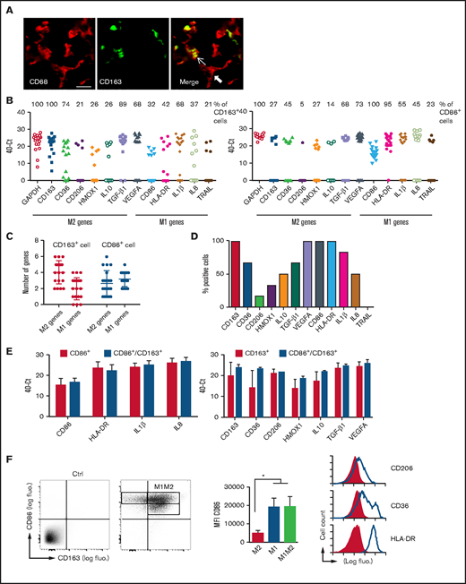 Polarization profile of TAMs in DLBCL. (A) Sections of DLBCL biopsies were stained by immunofluorescence for CD68 and CD163. Thin and thick arrows show an M2 and non-M2 macrophage, respectively. Photographs are representative of 10 patients. Scale bar, 10 µm. (B) Signal intensity (40−Ct value) of the indicated genes in CD163+ (left panel) and CD86+ (right panel) single cells. The percentage of CD163+ M2 and CD86+ M1 macrophages coexpressing the indicated M1 and M2 genes is shown on top of the panels. (C) The number of M1/M2 genes expressed in CD163+ M2 and CD86+ M1 single cells. (D) Phenotypic description of CD86+CD163+ noncanonical M1M2 macrophages at the mRNA level. (E) Expression levels (40−Ct value) of M1 genes in CD86+ M1 macrophages compared with CD86+CD163+ M1M2 cells (left panel) and expression levels of M2 genes in CD163+ M2 macrophages compared with CD86+CD163+ M1M2 cells (right panel). (F) Frozen DLBCL cell suspensions were analyzed by flow cytometry for expression of canonical CD86 M1 and CD163 M2 markers on gated CD68+ TAMs (left panel). Staining with control antibodies to determine the gating is also shown. Mean ± standard deviation (SD) fluorescence (fluo.) intensity for CD86 on the 3 TAM subtypes (middle panel). Surface expression of receptors in noncanonical M1M2 macrophages (right panel). Shaded line graphs represent isotype control. Data are mean ± SD and are representative of the 3 DLBCL patients shown in Figure 5B. *P < .05. IL, interleukin; TGF-β1, transforming growth factor β1; VEGFA, vascular endothelial growth factor A.