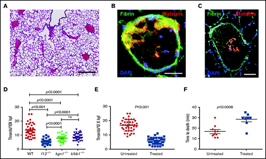Pulmonary emboli in mice treated with EV derived from L3.6 cells. (A) Paraffin section of lung from a WT mouse after L3.6 EV infusion into the IVC (original magnification ×5; H&E stain). Scale bar, 500 μm. Frozen sections of lung following EV infusion into the IVC and staining for platelet GP1b (CD42c, red) or fibrin (monoclonal antibody 59D8, green) at original magnification 320 (scale bar, 100 mm). (B) At original magnification 310 (scale bar, 200 mm. (C) DAPI (blue) stains cell nuclei. (D) Number of thrombi observed in a random 10× field following infusion of L3.6 EVs into WT C57BL/6, f12−/−, kng1−/−, and klkb1−/− mice. (E) Effect of preincubation of L3.6 EV with buffer alone (untreated) or CIP (treated) prior to IVC infusion on density of lung thrombi, measured per ×10× field. (F) Effect of preincubation of L3.6 EV with buffer alone (untreated) or CIP (treated) on time to death after IVC infusion. Each point represents an individual animal. Bars in graphs depict 95% confidence intervals , and comparisons between groups were performed using ANOVA and Student t tests. hpf, high-powered field; ns, not significant.