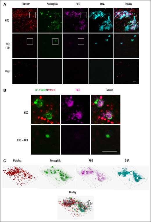 HIT IgG induces NETosis and ROS-containing thrombi. (A) Representative confocal microscopy images from n = 3 experiments of KKO-induced thrombi in whole blood showing platelets (AP2 AF594, red), neutrophils (anti-CD15 FITC, green), ROS (CellROX, magenta), and DNA release (Hoechst 3342, blue). Scale bar, 20 µm. (B) Magnified image of dotted area in panel A showing KKO-induced ROS in neutrophils and platelets. Scale bar, 20 µm. (C) Confocal microscopy analysis of KKO-induced thrombus in microfluidics channels. 3-Dimensional reconstruction and distribution of DNA (Hoechst 3342, blue), neutrophils (anti-CD15 FITC, green), platelets (AP2, AF594, red), and ROS (CellROX deep red, magenta) in thrombus.