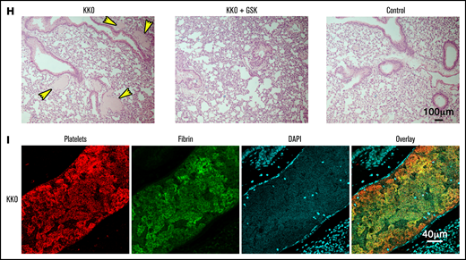 Inhibiting ROS protects mice from HIT-induced thrombosis but not thrombocytopenia. FcγRIIa+/hPF4+ double transgenic mice were injected IV with normal IgG or KKO. Heparin was injected intraperitoneally. Representative images and graphical representation of fluorescence intensity from platelet accumulation in mouse lungs from mice treated with normal IgG, KKO, and vehicle control, (A) KKO and DPI (n = 4), or (D) KKO and GSK2795039 (n = 3). (B,E) Platelet counts are represented as percentage of platelets relative to basal levels (n = 4). Rectal temperature of FcγRIIa+/hPF4+ mice treated with KKO or normal IgG, with and without (C) DPI (n = 4) or (F) GSK2795039 (n = 3). (G) Confocal images of lung lobe from mice treated with heparin and KKO, KKO and GSK2795039, or control IgG. 4′,6-Diamidino-2-phenylindole (DAPI)-stained nuclei (blue), platelet-rich thrombi (red). Scale bar, 1 mm.