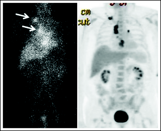 Biodistribution of 111In-basiliximab/DOTA at 144 hours in UPN-1 (left) and 18F-FDG-PET (right).