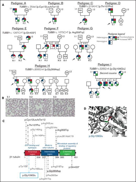 Family pedigrees and location of the β1-tubulin variants. (A) Pedigrees of the affected families with inherited thrombocytopenia. The index cases are indicated with black arrows. The upper right quarter red shading in symbols indicates individuals with thrombocytopenia, lower right quarter green shading denotes increased MPV, and upper and lower left quarter blue shading indicates heterozygous or homozygous for TUBB1 variant. NA, not available for the study; unlabeled symbols correspond to nonblood relatives not included in the study. (B) Representative peripheral blood smears from pedigree I after May-Grünwald Giemsa staining (×100). Variable platelet size was observed with large (arrows) and giant (cross) platelets. (C) Schematic representation of the β1-tubulin protein with all the reported variants. Variants in pedigrees reported in the present study are highlighted in bold; underlined variant is novel and the one within blue rectangle was found in homozygosity. (D) Structural analysis of the p.Gly109Glu missense variant using a β1-tubulin 3D model (software https://www3.cmbi.umcn.nl/hope/). The protein is colored in gray; the side chains of both the wild-type and the mutant residues are shown in green and red, respectively.