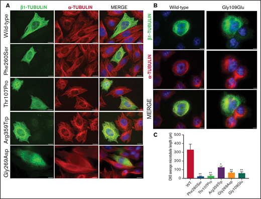 Effect of the novel missense variants in a CHO cellular model. Distribution of (A) transfected wild-type β1-tubulin, mutants p.260Ser, p.107Pro, p.359Trp, and p.269Asp and (B) mutant p.109Glu (in a different set of experiments), in transfected CHO cells by immunostaining for β1- (green) and α-tubulin (red). (C) Microtubule length in CHO cells transfected with wild-type or mutant β1-tubulin was assessed using ImageJ software. All β1-tubulin mutants resulted in significantly shorter microtubules. All images were acquired with a Carl Zeiss Axio Observer A1 fluorescence microscope with a 63× objective lens. Scale bars are 20 μm. Data are means ± SD of values obtained from at least 10 different microscopy fields. *P < .05; **P < .005.