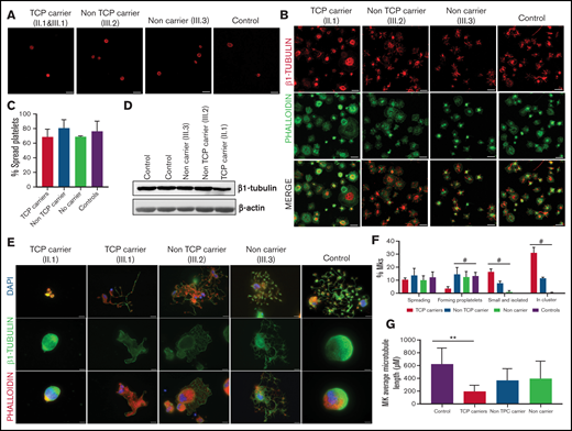 Effect of the p.Arg359Trp β1-tubulin variant in platelets and megakaryocytes. The functional and structural consequences of p.Arg359Trp β1-tubulin variant were assessed in members of Pedigree F. Immunofluorescence analysis of β1-tubulin was performed in platelets on poly-l-lysine–coated coverslips under (A) resting (platelet-rich plasma) and (B) spreading (washed platelets) conditions from p.Arg359Trp carriers with (II.1 and III.1) or without thrombocytopenia (III.2), a noncarrier (III.3), and an unrelated healthy control. Platelets were labeled with a β1-tubulin antibody (red) and with fluorescein isothiocyanate-phalloidin (green). Scale bars are 5 μm, and the objective lens is 63×. (C) Bar plot showing the percentage of spread platelets relative to total adhered platelets. Data are means ± SD of values obtained from at least 10 different microscopy fields in patient and control samples. (D) Representative Western blot picture of β1-tubulin levels in platelet lysates from p.Arg359Trp carriers with or without thrombocytopenia, a noncarrier, and 2 healthy controls, using β-actin as internal control. (E) Illustrative images of CD34+ peripheral blood cell–derived megakaryocytes in patients from Pedigree F (p.Arg359Trp carriers with or without thrombocytopenia and a noncarrier) and healthy controls. MKs were labeled with β1-tubulin (green) and rhodamine-phalloidin (red). Nuclei were stained with 4′,6-diamidino-2-phenylindole (DAPI; blue). Images were acquired in a Carl Zeiss Axio Observer A1 fluorescence microscope with a 63× objective lens. Scale bars are 5 μm. (F) Classification of MKs in family members and controls. Polynucleated cells extending protrusions with terminal tips were considered as proplatelet-forming MKs, whereas those displaying a flattened shape with actin organized in focal adhesion points and fibers as spread MKs. Some MKs were small and isolated, whereas MKs that were present in aggregates of 2 or more MKs were defined clusters. At least 100 MKs from 5 different replicates were analyzed; #P < .05 vs TCP carriers. (G) Microtubule length in CD34+ peripheral blood cell–derived MKs from controls and patients with the p.Arg359Trp β1-tubulin variant was assessed using the ImageJ software. Data are mean ± SD of values obtained from at least 6 different microscopy fields. TCP, thrombocytopenic; non-TCP, nonthrombocytopenic. **P < .005.