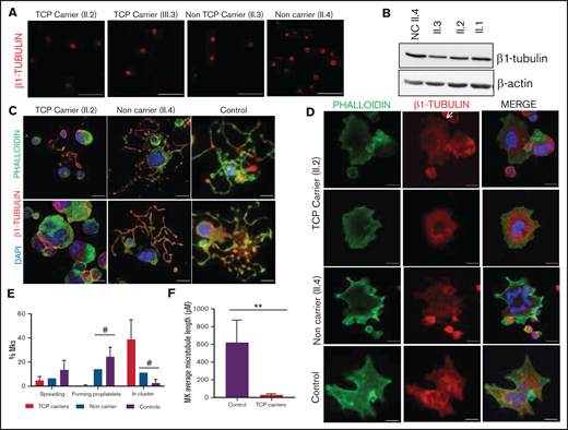 Effect of the p.Gly269Asp β1-tubulin variant in platelets and megakaryocytes. The functional and structural consequences of the novel p.Gly269Asp β1-tubulin variant were assessed in members of Pedigree H. (A) Immunofluorescence analysis of β1-tubulin was performed on poly-l-lysine–coated coverslips in platelets (platelet-rich plasma) from p.Gly269Asp carriers with (II.2 and III.3) or without thrombocytopenia (II.3) and a noncarrier (II.4). Platelets were labeled with a β1-tubulin antibody (red). Scale bars are 5 μm, and the objective lens is 63× (magnification 3×). (B) Western blot pictures of β1-tubulin levels in platelet lysates; β-actin was used as an internal control. (C) Representative images of CD34+ peripheral blood cell–derived MKs in a thrombocytopenic p.Gly269Asp carrier (II.2), noncarrier (II.4), and healthy control. (D) Representative images of spread MKs. MKs were labeled with β1-tubulin (green) and rhodamine-phalloidin (red). Nuclei were stained with DAPI (blue). The white arrow indicates a MKs with disorganized β1-tubulin. Images were acquired in a Leica SP8 confocal microscope with a 63× objective lens (magnification 1.5×). Scale bars are 5 μm. (E) Classification of MKs in family members and controls (as described in Figure 3; #P < .05 vs TCP carriers). (F) Microtubule length of CD34+ peripheral blood cell–derived MKs from controls and patients with p.Gly269Asp β1-tubulin variant was assessed using ImageJ software. Values are mean ± SD of values obtained from at least 10 different microscopy fields. TCP, thrombocytopenic; non-TCP, nonthrombocytopenic. **P < .005.