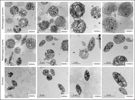 The variant Gly109Glu in β1-tubulin alters platelet ultrastructure. Electron microscopy of platelets from 2 homozygous and a heterozygous carrier of the β1-tubulin p.Gly109Glu and from 2 healthy controls. In contrast to control platelets, most platelets from homozygous p.Gly109Glu carriers were round and large and showed a slightly hypertrophic open canalicular system and an irregular membrane demarcation system (white arrows and asterisks, respectively). Magnification for each image is shown (8000-15 000×). Images were acquired in a Philips/FEITecnai12 transmission electron microscope.