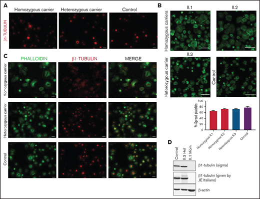 The p.Gly109Glu variant disrupts β1-tubulin incorporation into microtubules with a minimal effect on platelet spreading. Representative immunofluorescence analysis of β1-tubulin in patient (Pedigree I) and control washed platelets in (A) resting and (B-C) spreading conditions. Platelets were labeled with a β1-tubulin antibody (red) and with FITC-phalloidin (green). Images were acquired in a Carl Zeiss Axio Observer.A1 fluorescence microscope with a 100× objective lens. Scale bars are 5 μm. Platelet spreading on poly-l-lysine was quantified, and the percentage of totally spread platelets relative to the total adhered platelets is shown in the bar plot. Values are mean ± SD. Images were acquired in a Leica SP8 confocal microscope with a 63× objective lens (magnification, 2×). Scale bars are 20 μm. (D) Western blot pictures of β1-tubulin levels in platelet lysates from patients and controls, using 2 different β1-tubulin antibodies; β-actin was used as internal control.