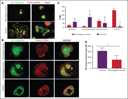 Effect of the TUBB1 p.Gly109Glu variant in CD34+ peripheral blood cell–derived MK cultures. (A) Representative images of CD34+ peripheral blood cell–derived MKs in 2 controls and in homozygous carriers (pedigree I) of the novel variant p.Gly109Glu. (B) Detailed images of spread MKs. MKs were labeled with β1-tubulin (green) and rhodamine-phalloidin (red). Nuclei were stained with DAPI (blue). Images were acquired in a Carl Zeiss Axio Observer.A1 fluorescence microscope with a 63× objective lens. Scale bars are 5μm. (C) Classification of MKs (as described in Figure 3; #P < .05) in homozygous carriers and controls. (D) Microtubule length in MKs from controls and homozygous carriers of the p.Gly269Asp β1-tubulin variant was assessed using ImageJ software. Values are mean ± SD of values obtained from at least 6 different microscopy fields. *P < .05.