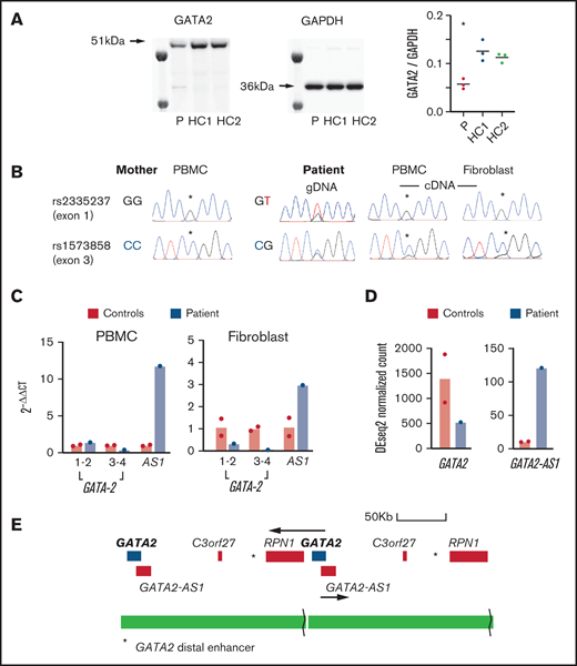 Expression of GATA2 and GATA2-AS. (A) Western blots of GATA2 and GAPDH in fibroblasts from the patient (P) and 2 healthy controls (HC1, HC2) showing ∼50% reduction in the ratio of GATA2/GAPDH. Samples were loaded in triplicate for quantification as shown. Three independent experiments were performed with similar results. *P < .05 vs control. (B) Allelic expression was investigated by preparing genomic DNA (gDNA) and complementary DNA (cDNA) from maternal PBMCs, patient PBMCs, and fibroblasts. Two single-nucleotide polymorphisms rs2335237 (exon 1) and rs1573858 (exon 3), heterozygous in the patient and homozygous in the mother, showed preferential expression of the duplicated maternal allele above the peak heights observed in the genomic DNA sequence chromatogram (asterisks). (C) Quantitative polymerase chain reaction analysis of GATA2 expression in PBMCs and fibroblasts comparing ΔΔCt (GATA2-GAPDH) in 2 controls and the patient using 3 primer pairs for GATA2 exons 1-2, exons 3-4, and the GATA2 anti-sense transcript (AS1). (D) GATA2 and GATA2-AS1 expression determined from RNA sequencing data in PBMCs from the patient and 2 controls. (E) Structure of the duplication showing the position of the GATA2 distal enhancer (asterisk) in relation to the second copy of GATA2 and the potential hybrid transcript of GATA2 and RPN1.