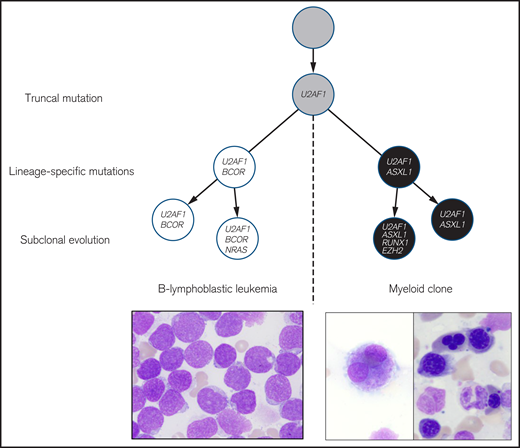 Branched evolution of a U2AF1-mutated progenitor to distinct B-lymphoblast and myeloid clones. Truncal mutation: Initially, a U2AF1 mutation is proposed to have arisen in a lineage-uncommitted progenitor. Lineage-specific evolution: Subsequently, separate subclones acquired BCOR and ASXL1 mutations, which appeared lineage restricted. Subclonal evolution within a lineage: Finally, the B-lymphoblast and myeloid clones continued to evolve by acquisition of additional subclonal mutations. Morphologic findings of increased blasts after initial minihyper CVD (lower left, 600× original magnfication) and morphologic dyspoiesis after 2 cycles of inotuzumab are shown. Dysplastic features included megakaryocytes with abnormal lobation (middle image, 600× original magnification) and erythroid multinuclearity, nuclear irregularity, and nuclear fragmentation (right, 2100× total magnification). All microscopic images represent May Grunwald-Giemsa stains.