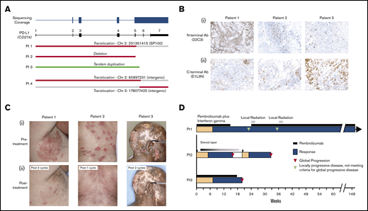 Pembrolizumab treatment of mycosis fungoides with PD-L1 structural variants. (A) Depiction of discovered PD-L1 structural variants. (B) Immunohistochemical staining of PD-L1 using 22C3 (i) and E1L3N (ii) clones for 3 pembrolizumab-treated patients. (C) Photographs of 3 patients with MF and LCT treated with pembrolizumab-based therapy before (i) and after (ii) treatment. (D) A swimmer’s plot representation of the responses to pembrolizumab-based therapy.