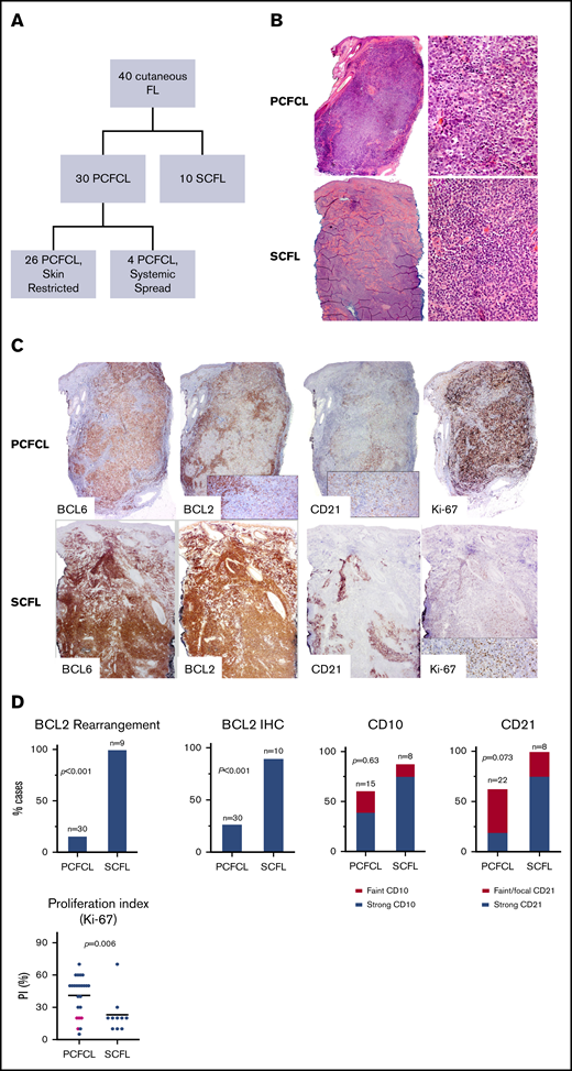 Cutaneous follicular lymphoma cases and their immunohistological characteristics. (A) Summary of the FL cases included in the study. (B) Morphology of cutaneous follicle center lymphomas. PCFCL nodular architecture. Hematoxylin and eosin (H&E) staining, low power (left; original magnification ×40) and high power (right; original magnification ×1000). SCFL. H&E staining, low power (left; original magnification ×40) and high power (right; original magnification ×1000). (C) IHC staining (original magnification ×100) of PCFCL and SCFL specimens: BCL6, BCL2, CD21, and Ki-67. (D) Comparison graphs showing differences in BCL2 rearrangement and BCL2, CD10, CD21, and Ki-67 staining between cases of PCFCL and SCFL. Pink dots in Ki-67 histogram represent cases of PCFCL with systemic spread.