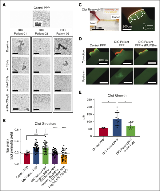Effects of tPA-FSN treatment on ex vivo DIC patient plasma samples. Confocal microscopy (Zeiss LSM 710 Laser Scanning Microscope) images (A) and fiber density quantification (B) of DIC patient plasma clot samples compared with normal human plasma clots. A C-Apochromat 63× 1.2W objective lens was used to capture 1.89-μm z-stack images, which were analyzed using ImageJ to make 8-bit 3D projections. (B) Fiber density was quantified by determining the ratio of black (fiber) over white (background) pixels in each binary image. Unloaded FSNs, tPA-FSNs, or tPA-CS-IgG (1 mg/mL) were also incorporated into DIC patient plasma clots that were examined with confocal microscopy. Plasma samples from 3 DIC patients were examined, and pooled data from those samples was used for statistical analysis. (C) A custom-made Y-shaped microfluidic device was used to test plasma samples under flow at a wall shear rate of 10 s−1. A stationary fibrin clot was formed at the top Y junction with DIC patient plasma containing Alexa-Fluor 594–labeled fibrinogen for visualization. Flow solutions contained DIC patient plasma and Alexa-Fluor 488–labeled fibrinogen for visualization. (C-D) Images from an EVOS FL Auto Imaging System at 10× magnification were captured at the Y junction and upstream inlet channel and are shown with a reference to how clot growth was measured. (E) Quantification of clot growth at the stationary clot boundary was performed with ImageJ software. Normal healthy human plasma acted as a control. For each plasma sample from a DIC patient (n = 3), 3 trials were conducted with plasma alone in the flow solution, and 3 trials were conducted with plasma containing tPA-FSNs in the flow solution. All data are presented as average ± standard deviation. Data sets were analyzed via a 1-way ANOVA with a Tukey’s post hoc test using a 95% confidence interval. *P < .05; ****P < .0001.