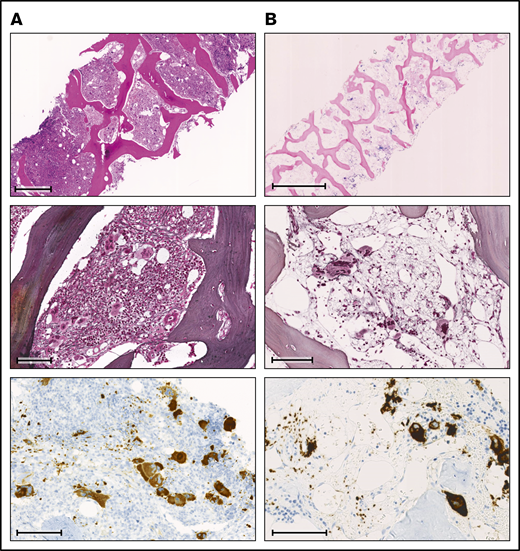Comparison of BM biopsies at diagnosis and during follow-up. (A) BM biopsy at diagnosis. (B) BM biopsy at follow-up 6 years later. Row 1: (A) H&E stain; scale bar, 500 μm. (B) Giemsa stain; scale bar, 1000 μm. Row 2: (A-B) Gomori methenamine silver stain; scale bar, 100 μm. Row 3: (A-B) CD61 immunohistochemistry; scale bars, 100 μm.