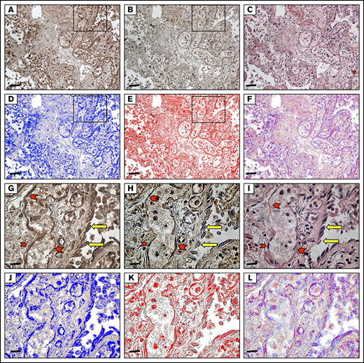 Immunohistochemical analysis of autoptic lung tissue from a patient with COVID-19. (A) Immunostaining for angiopoietin-2 (20×): immunohistochemistry shows immunoreactivity in the endothelia, pneumocytes, and macrophages. Scale bar, 6.7 μm. (B) Immunostaining for Tie2 (20×): the same field as in Figure 1. Tie2 showed the same immunoreactivity observed for angiopoietin-2 immunoreaction. (C) Hematoxylin and eosin staining (20×): diffuse alveolar damage in COVID-19, interstitial inflammation, and dilated capillaries in the alveolar wall. The alveolar spaces show fibrin and macrophages. (D-F) The brown DAB signal for angiopoietin-2 shown in panel A was converted into a blue color and that for Tie2 shown in panel B was converted into a red color. The images in panels D and E were merged, resulting in a violet color, where the angiopoietin-2 and Tie2 colocalize. (G-I) Higher magnification (63×) of the inset in panel A highlights angiopoietin2 and tie2 immunoreactivity both in endothelia (red arrowheads) and in pneumocytes (yellow arrows). Scale bar, 1.7 μm. (J-L) The brown DAB signal for angiopoietin-2 shown in panel G was converted into a blue color and that for Tie2 shown in panel H was converted into a red color. The images in panels J and K were merged, resulting in a violet color, where the angiopoietin-2 and Tie2 colocalize.