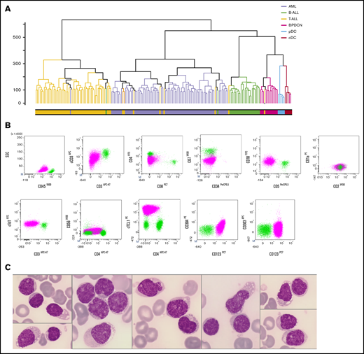 Reclassifying a T-ALL iu BPDCN by gene expression profiling. (A) Unsupervised hierarchical clustering of 176 AL patients and 10 normal DC transcriptomes: B-ALL (green), T-ALL (yellow), AML (lavender), BPDCN (magenta), reclassified patient P13 (yellow with gray dot), normal cDC (red), and normal pDC (light blue). (B) Flow cytometry analysis of patient P13 BM: blastic population (magenta) and CD45+ lymphocytes (light green). The blastic population expresses CD45low cCD3low and CD4+, CD2+, CD10+ but no CD7 and surface CD3. The blastic population expresses the pDC markers CD123, TCL1high and a low level of CD304. CD303 and CD56 were not expressed. (C) BM examination of patient P13 showed blasts, with regular nuclei and small nucleoli, no cytoplasmic granulation, and rare small vacuoles and/or pseudopodia (May-Grünwald-Giemsa stain, magnification ×1000).