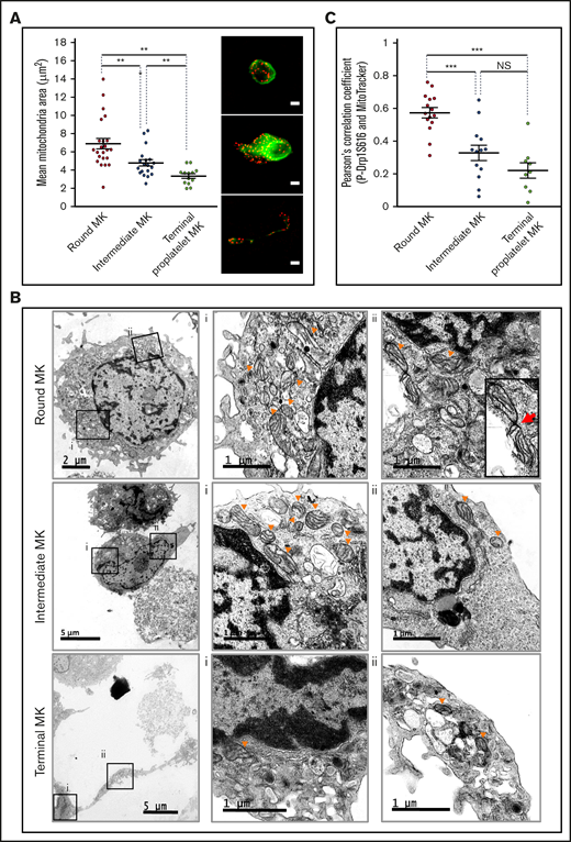 Changes in mitochondrial dynamics during proplatelet formation. (A,C) Mature MKs were incubated for 5 hours before being processed for fluorescence microscopy after MitoTracker labeling. (A) Mean mitochondrial areas of individual round (red dot), intermediate (blue dot), and terminal (green dot) MKs. Dot plots show individual data and median lines (n = 3, Mann-Whitney U test); representative images of MitoTracker (red) and α-tubulin (green) labeling are shown on the right. Bars represent 10 µm. **P < .01. (B) Mature MKs were collected and processed for transmission electron microscopy; images illustrate round (top), intermediate (middle), and terminal (bottom) MKs. Boxes (Bi-ii) indicate areas enlarged for visualization of the mitochondria, at original magnification ×3000 for round/intermediate MKs and ×4000 for terminal MKs. Arrowheads indicate representative mitochondria; red arrow indicates a mitochondrial fission. (C) PhosphoSer616-Drp1 antibody (green) was used in colabeling with MitoTracker (red) and processed for fluorescence confocal microscopy. Pearson’s correlation coefficients were measured for the 2 fluorescent signals (MitoTracker, P-Ser616Drp1) by using the JACoP plugin of ImageJ for the indicated MKs (dots). Dot plots show individual data and median lines (n = 3; ***P < .001; Mann-Whitney U test).