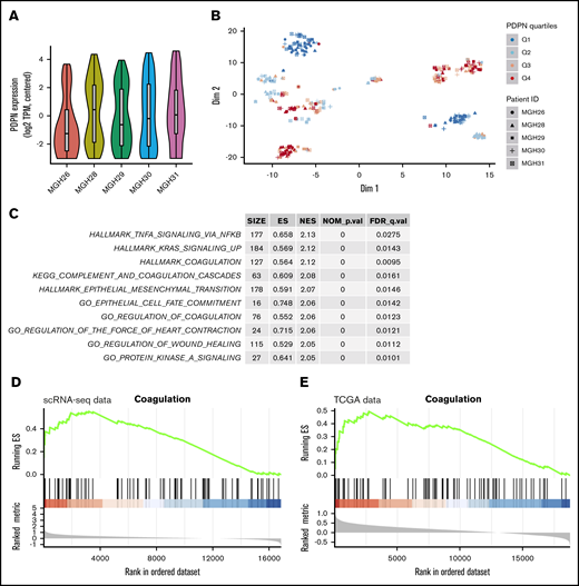 PDPN-expressing cell populations in glioblastoma. (A) Violin plot demonstrates the heterogeneous expression of PDPN among cell populations within individual GBMs. (B) t-SNE analysis captures the distinctiveness of PDPN+ and PDPN− cell subpopulations of 5 individual GBMs. These cellular subsets, comprising individual cells originating from different GBM tumors, exhibit transcriptional similarities. PDPN expression was ranked by quartiles Q1 to Q4 in an increasing order of expression. (C) Pathway enrichment analysis shows the top 10 enriched pathways in cells with the highest PDPN expression (Q4) compared with those with the lowest PDPN expression (Q1). Of note is the preponderance of coagulation and inflammatory pathways according to MSigDB and Kyoto Encyclopedia of Genes and Genomes (KEGG) gene sets. (D) GSEA plot showing pronounced enrichment of Hallmark Coagulation genes in cells with high PDPN expression (Q4) in the scRNA-seq data set compared with those with low PDPN expression (Q1). (E) This observation persists when analyzing The Cancer Genome Atlas (TCGA) bulk tumor samples (right panel); Hallmark Coagulation genes are similarly enriched in tumors with high PDPN expression (Q4) compared with those with low expression (Q1).