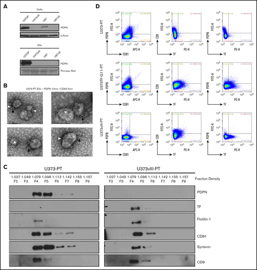 PDPN is released from glioma cells as cargo of EVs. (A) Detection of PDPN immunoreactivity in glioma cells and EVs; highly positive U373P cells release ample PDPN+ EVs relative to PDPN-downregulated U373vIII and U87vIII cell lines. Lower levels of PDPN expression in U87P cells result in the absence of PDPN signal in EVs (n = 3). (B) Immunogold staining and electron microscopy of U373P EVs for PDPN (10-nm gold particles, black arrows) and exosomal marker CD63 (5-nm gold particles, white arrowheads). Multiple small EVs (≤100 nm) stain for both PDPN and CD63 (n = 2). (C) Glioma EVs float at exosomal density in the iodixanol gradient (F4-F5) and commonly express multiple EV markers (flotillin-1, CD81, syntenin, and CD9). EVs released from EGFRvIII− (U373PT) cells carry PDPN, but not TF, whereas their isogenic counterparts from EGFRvIII+ cells (U373vIII) carry TF, but not PDPN (n = 3). (D) Single EV nanoflow cytometry of EV populations from glioma cells expressing PDPN alone (U373PT), PDPN and TF (U373TF-G11-PT), or TF alone (U373vIII-PT). EVs are heterogenous, but their subsets coexpress CD81, PDPN, and TF (n = 5) (supplemental Methods).
