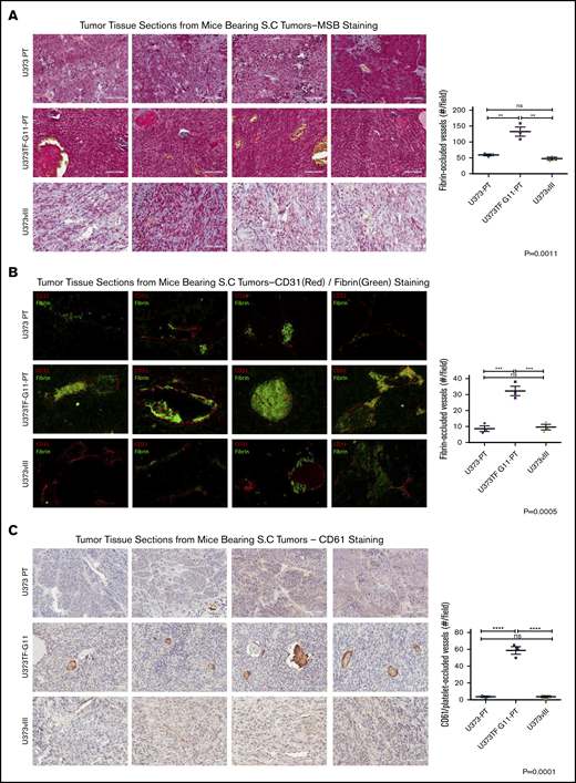 Cooperation between PDPN and TF in tumor microthrombosis in glioma xenografts. (A) Martius scarlet blue trichrome (MSB) staining for thrombi in 4 representative xenografts expressing PDPN alone (U373PT), PDPN and TF (U373TF-G11-PT), or TF alone (U373vIII) (left panels); bars represent 100 μm. Quantification of occluded vessels containing fibrin thrombi (right panel) indicates significant elevation in the case of U373TF-G11-PT (PDPN+/TF+) tumors. (B) Immunofluorescent staining of tumors for endothelial cells (CD31, red) and fibrin (green) (left panels). Fibrin-occluded vessels predominated in U373TF-G11-PT tumors (PDPN+/TF+) (right panel); magnification ×400. (C) Immunohistochemical staining of glioma xenografts for mouse platelet marker CD61 (left panels). Platelet-rich thrombi were most abundant in U373TF-G11-PT (PDPN and TF–double expressing) tumors (right panel); bars represent 100 μm. **P ≤ .01, ***P ≤ .001, ****P ≤ .0001, ANOVA multiple-comparison analysis. ns, nonsignificant