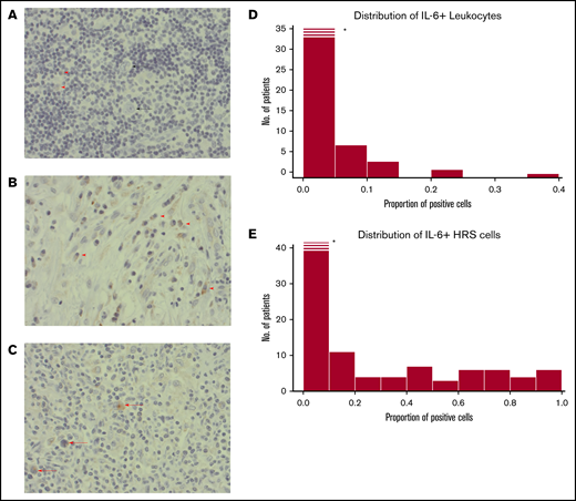 Histopathological images. (A) A case with weak staining of IL-6+ leukocytes (red arrowheads), and negative HRS cells (black arrow). (B) Example of a case with a high frequency of IL-6+ leukocytes (red arrow). No HRS cells in this image. (C) A case with several IL-6+ HRS cells (red arrowheads). (A-C) Immunohistochemical staining with IL-6 antibody; original magnification ×400. (D) Histogram for IL-6 scoring distribution for positive leukocytes. X-axis proportions of cells stained positive for IL-6 antibody in the TME of cHL. Y-axis, Frequency of patients. *The first bar is cropped for illustrative purposes. (E) The same as for panel D but for HRS cells. Histograms in panels D and E show a nonnormal distribution: the Shapiro-Wilk normality test (P = .001).