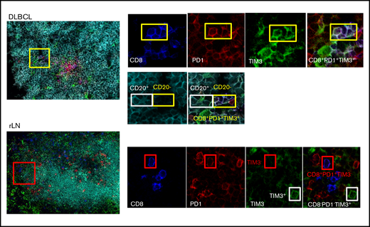 CD8+T-cell expression of PD1 and TIM3 in DLBCL vs rLN and their colocalization with B cells. In this DLBCL sample, the yellow box shows 4 cells expressing CD8 (blue), PD1 (red), and TIM3 (green) in contact with CD20+ lymphoma cells, identified by the white box. These CD8+ T cells frequently localize in the CD20+ infiltrate (turquoise). In this rLN sample, the CD8+ T cells (blue) sometimes express PD1 (red) but not TIM3 (green). They are found at the periphery of the CD20+ cluster. Original magnification ×60.