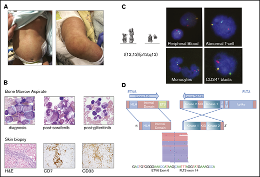 Clinical, pathologic, and molecular characteristics of MLN-Eo with ETV6-FLT3 fusion in the study patient. (A) Skin rash at presentation. (B, top) Representative histologic smears from bone marrow at diagnosis, following sorafenib therapy, and in full MRD-negative complete response after gilteritinib. (B, bottom) Skin biopsy samples showed involvement by same infiltrative process affecting bone marrow. (C) Partial karyogram showing t(12;13)(p13;q12) and FISH confirming ETV6 rearrangement in multiple sorted abnormal cell populations. (D) Schematic illustration of fusion gene product and transcript sequence of the ETV6 (NM_001987)-FLT3 (NM_004119) in-frame fusion product. Exons 1-6 of ETV6 are fused to exons 14-24 of FLT3, which include the kinase domain. Red and blue rectangles represent bidirectional RNA-sequencing reads supporting the fusion breakpoint. H&E, hematoxylin and eosin; HLH, helix-loop-helix domain; KID, kinase insert domain.