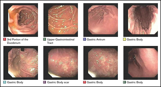 EGD images documenting pathologic complete response. EGD images from patient 6, whose experienced spontaneous normalization without salvage treatment.