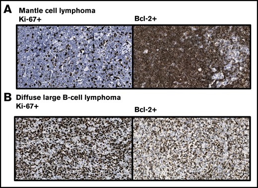 Immunohistochemical staining pattern of lymphoma with the horseradish peroxidase–labelled Ki-67 antibody MIB-1 and Bcl-2 antibody Bcl2/100, showing their reactivity in mantle cell lymphoma and diffuse large B-cell lymphoma. Cells were stained with 3,3'-diaminobenzidine for detection of Ki-67 and Bcl-2 expression (brown staining) and with hematoxylin for visualization of nuclei (blue staining). (A) In this mantle cell lymphoma, Ki-67 is weakly expressed, whereas strong expression of Bcl-2 is observed. However, these markers are known to be differentially expressed in mantle cell lymphoma. (B) Strong Ki- 67 and Bcl-2 expression is observed in the presented diffuse large B-cell lymphoma. These markers are primarily used for subtyping this group of malignancies. Provided by Ruud Clarijs, Department of Pathology, Zuyderland Medical Centre (magnification ×400).