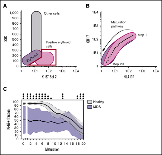 Schematic representation of the different steps to determine the proliferative and (anti-)apoptotic fractions in the different differentiation stages of maturating erythroid cells. (A) Either the Ki-67+ or Bcl-2+ fraction was first gated. (B) The maturation pathway was then drawn (based on CD117 and HLA-DR expression in the case of erythroid differentiation) and automatically divided into 20 equal maturation stages by the Infinicyt (version 2.0) software package. (C) The Ki-67+ or Bcl-2+ fraction was then calculated per maturation stage and plotted against the different maturation stages. The proliferative fraction of erythroid cells, as determined by the Ki-67+ fraction, was significantly lower for MDS patients in all stages of maturation compared with the proliferative fraction in healthy BM.32 SSC, side scatter.