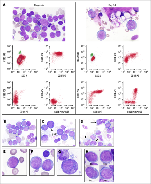 Morphologic and immunophenotypic patterns of differentiation in individual patients. (A) Monocytic differentiation of leukemic cells. At diagnosis, blasts in this patient were small to intermediate in size with round nuclei and small amounts of cytoplasm and were negative for monocytic markers (CD11b, CD14, and CD64) by flow cytometry. At day 14 postinduction, leukemic cells showed morphologic findings characteristic of monoblasts/promonocytes, with increased cell size, folded nuclei, and increased cytoplasm with cytoplasmic vacuolization. Flow cytometry showed expression of CD11b, CD14, and CD64, as well as increased expression of CD33, consistent with monocytic differentiation. (B-C) Granulocytic differentiation of leukemic cells. (B) At diagnosis, blasts in this patient were small to intermediate in size with round nuclei and small amounts of cytoplasm without prominent cytoplasmic granulation. (C) At day 14, many cells (35% by manual differential) were larger in size with increased cytoplasm and prominent azurophilic cytoplasmic granules (arrow). Also present were blasts (12.5% by manual differential) that resembled those seen at diagnosis (arrowhead). A BM biopsy performed on day 30 postinduction (not shown) showed a normal BM aspirate differential count with 0% myeloblasts. (D) Day 21 aspirate smear from a patient showing both monocytic differentiation, with large cells with folded nuclei and abundant cytoplasm (block arrow) as well as granulocytic differentiation, with cells showing prominent cytoplasmic granulation (arrow). (E-G) A case with delayed differentiation, apparent at day 21. (E) At diagnosis, blasts were intermediate in size with oval nuclei, multiple distinct nucleoli, and small amounts of cytoplasm. (F) At day 14, blasts showed similar morphologic features, without evidence of differentiation. (G) At day 21, blasts showed increased size, more abundant cytoplasm, and prominent cytoplasmic granulation. (H) A patient with persistent AML, without evidence of differentiation. Blasts showed similar morphologic features at all timepoints. (A-H) Wright stain, original magnification ×1000; acquired on an Olympus BX53 microscope with an Olympus DP73 camera, using Olympus cellSens standard software. APC, allophycocyanin; Dx, diagnosis; PE, phycoerythrin; PerCP, peridinin-chlorophyll protein complex; SSC-A, side scatter–area.