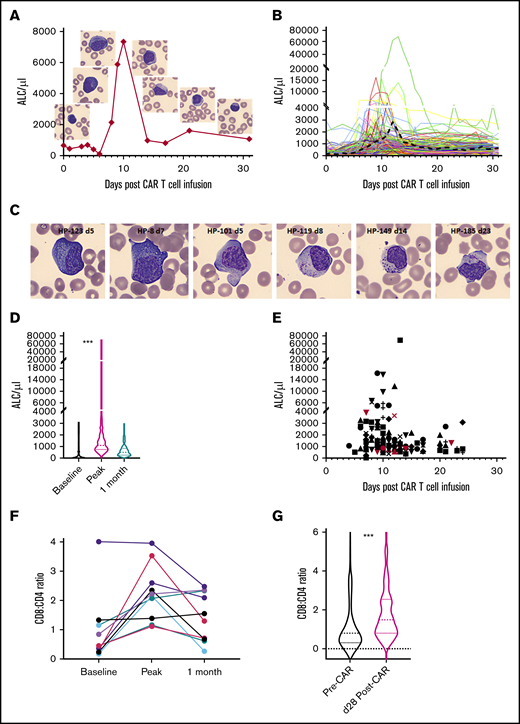 Lymphocyte expansion after CAR T-cell infusion. (A) ALC proliferation kinetics and concurrent peripheral smear images of atypical lymphocytes in (eventual) SR patient HP-101. (B) ALC kinetics of the entire cohort (n = 164) showing lag, expansion, and contraction phases. Black dashed line depicts the mean. The y-axes are depicted in a linear scale similar to ALC graphs in the electronic medical record. Split axes are used to highlight the entire spectrum of peak ALCs. (C) Spectrum of atypical lymphocytes after CAR infusion. Atypical features include markedly basophilic cytoplasm (HP-123 and HP-8), cytoplasmic projections (HP-101), polarized granules (HP-119), chunky granules (HP-149), and azurophilic rods (HP-185). Patient code and days post–CAR infusion are shown in parentheses. Representative CellaVision images at ×500 original magnification. Background RBCs demonstrate uniformity of smears and magnification. (D) Violin plots (median, quartile ranges, and distribution) of baseline and peak and 1-month ALC across the cohort (n = 164; ***P < .0001, Kruskal-Wallis test). (E) Timeline of peak ALC across the cohort (n = 164). Red symbols depict NRs. The 2 NRs with the highest ALCs underwent reinfusion of CAR T cells or pembrolizumab during the first month. Different shapes indicate individual patients. (F) Increased CD8 T cells at peak expansion compared with that observed before and 1 month after CAR infusion (n = 10 cases). (G) Violin plots showing increased CD8/CD4 ratio at day 28 compared with baseline across the cohort (n = 166; ***P < .0001, Wilcoxon test).