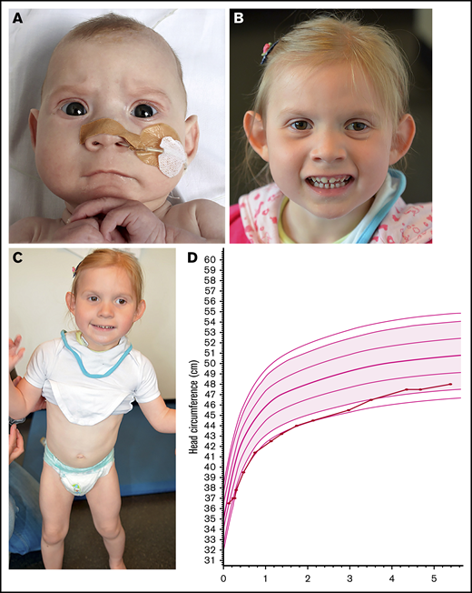 A patient with BCL11A haploinsufficiency due to de novo p.Glu485X variant. Patient at age 4 months (A) and at age 3 years and 6 months (B). Facial features included strabismus divergens, mild left ptosis, flat midface, flat philtrum, thin upper lip, and protruding ears with thin, flat helixes, and attached earlobes. (C) A muscular build and instable gait present at 3 years and 6 months. (D) Head circumference evolved from −2.5 SD up to the age of 3 years to within normal range at 7 years.