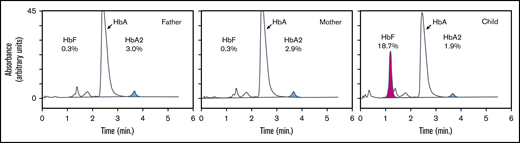Hemoglobin analysis of peripheral blood. Hemoglobin subtypes of peripheral blood were analyzed by high-performance liquid chromatography. The percentages of total hemoglobin are indicated for HbA (α2β2), HbA2 (α2δ2; blue), and HbF (α2γ2; pink).