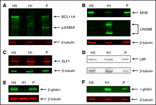 Protein expression analysis of transcription factors, LIN28B, and globins. Western blots showing expression of BCL11A (XL isoform and p.Glu485X) (A), MYB and LIN28B (B), KLF1 (C), LRF (D), β-globin (E), and γ-globin (F). β-tubulin was used as loading control. Protein extracts were derived from HUDEP1 cells (H1), HUDEP2 cells (H2), and patient HEPs (P).