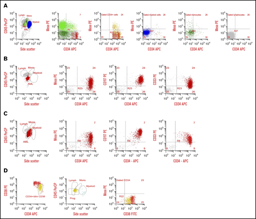 Cell surface MSLN expression in AML. (A) Flow plots from a 5-year-old with MSLN+ AML with predominantly CD34−/MSLN+ leukemia. First plot with CD45/side scatter (SSC) distribution showing leukemic blasts (bright green), normal monocytes (dark green), myeloid cells (blue), and normal lymphocytes (gray). In the second plot, AML is shown in bright green, monocytes are dark green, and CD34+ cells are red. The AML is predominantly CD34− but both CD34− and CD34+ subset express MSLN. The third plot is gated on CD34+ cells, with CD34+/MSLN+ leukemic blasts in yellow and CD34+ normal progenitor cells in red. The fourth, fifth, and sixth plots show normal myeloid cells (blue), normal monocytes (green), and normal lymphocytes (gray), respectively, none of which express MSLN. (B) Flow plots from a 12-year-old with MSLN+/CD34+ AML. First plot with CD45/SSC distribution showing leukemic blasts (red), a few normal monocytes (green), and normal lymphocytes (gray). In the second plot the CD34+ blasts demonstrate MSLN expression. Third plot confirms the myeloid nature of CD34+/heterogenous CD117+ abnormal blasts (red), and normal lymphocytes (gray). The fourth plot confirms myeloid nature of the CD34+/CD33+ blasts (red), with lymphocytes (gray). (C) Flow plots from a 17-year-old patient with MSLN+/CD34+ AML. First plot with CD45/SSC distribution showing leukemic blasts (red), and few normal myeloid and normal lymphocytes (orange and gray, respectivly). Second plot shows heterogeneous MSLN expression on abnormal CD34+ myeloblasts (red) and normal lymphocytes (gray). The third plot confirms the myeloid nature of CD34+/CD117+ abnormal blasts (red) and normal lymphocytes (gray). (D) Normal CD34+ progenitor cells from an 18-year-old are negative for MSLN expression. The first plot shows CD34+ cells with early progenitors with bright CD34+/dim CD38+ expression in yellow, the second plot shows the characteristic position of these early progenitors (yellow) by CD45 and SSC, and the third plot shows there is no MSLN expression on any normal CD34+ cells, either early progenitors (yellow) or uncommitted progenitors (red). APC, allophycocyanin; FITC, fluorescein isothiocyanate; Lymph, lymphocytes; Meso, mesothelin; Mono, monocytes; PE, phycoerythrin; PerCP, peridinin-chlorophyll-protein complex; Prog, progenitors.
