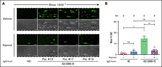 Iloprost inhibits ICU COVID-19 IgG-induced increased thrombus formation. (A) PRP from healthy individuals with the blood group O was incubated with HC or ICU COVID-19 IgG in the presence of vehicle or Iloprost (20 nM). After reconstitution into autologous whole blood, samples were perfused through microfluidic channels at a shear rate of 1500-1 (60 dyne) for 5 minutes. Pictures were acquired at x20 magnification in fluorescent (upper panel) as well as in the BF channel (lower panel). Scale bar 50 µm. (B) Mean percent of SAC by thrombus ± SEM induced by HC or ICU COVID-19 IgG in the presence of vehicle or Iloprost (20 nM). The number of patients and healthy donors tested is reported in each graph. See Figure 1 for P values and abbreviation definitions.