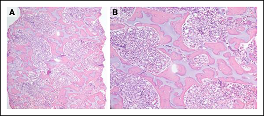 Severe phenotype of the subject with SBDS c.183_184delTAinsCT/c.523C>T (p.Lys62*/p.Arg175Trp) and lacking the c.258 + 2T>C variant. (A-B) Bone marrow biopsy demonstrating irregular islands of cartilage surrounded by osteoid with increased bone-to-marrow space ratio and a loose fibroblastic network surrounding the bone islands. Original magnification ×40 (A), original magnification ×200 (B); hematoxylin and eosin stain.
