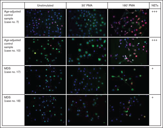 Visual assessment of NET formation. NET formation was assessed microscopically in unstimulated neutrophils and after 30 minutes and 180 minutes of stimulation with PMA, in MDS patients and age-adjusted normal controls (representative examples).