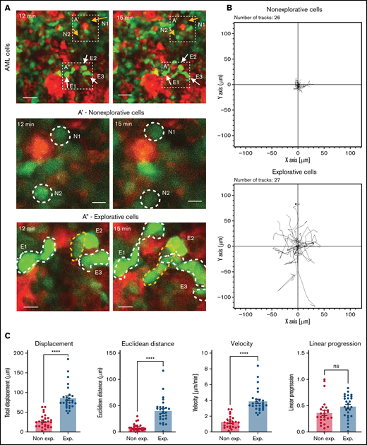 IVM identifies subsets of AML cells affected by MMP inhibition. (A) Selected frames from representative time-lapse IVM of BM calvarium with intermediate infiltration. Red: mTomato+ healthy hematopoietic cells; green: YFP+ AML cells. White and yellow arrows: examples of explorative and nonexplorative cells, respectively. Boxed areas are shown at higher magnification in A’ and A”, where nonexplorative and explorative cells’ morphology is highlighted by dashed lines. Scale bars represent 80 µm in A and 25 µm in A’ and A”. (B) Rose plots showing tracks of nonexplorative and explorative AML cells. n = 26 nonexplorative and n = 27 explorative AML cells. (C) Quantification of displacement (track length), Euclidean distance (distance from track start to end points), velocity, linear progression, and (D) circularity and perimeter variance of nonexplorative and explorative cells. n = 27 explorative cells and n = 26 nonexplorative cells pooled from 8 fields of view from 3 mice in 2 independent experiments. (E) Diffusion coefficient of explorative (blue lines) and nonexplorative (orange lines) cells represented as TAMSD. Red lines are the fit by ordinary least square of the mean of all trajectories (black dots). (F) Frequency of explorative cells observed per field of view. n = 10 FoWs from 4 mice from 3 independent experiments. (G) Selected, representative timeframe of time-lapse IVM showing mTomato+ AML blasts (red) and in vivo immunostaining for CX3CR1 (turquoise). Scale bar represents 50 µm. (H) Boxed areas in (G) shown at higher resolution are examples of CX3CR1+ explorative and CX3CR1- nonexplorative AML cells (scale bar = 10 µm). (I) Percentage of CX3CR1+ explorative and nonexplorative AML cells per field of view analyzed. n = 8 fields of view pooled from 3 mice. (J) Simulation results when each field of view is initially seeded by 2 adjacent cells, and progeny is generated according to available proliferation rates. Left: all cells are explorative. Middle: all cells are nonexplorative. Right: 10% of cells are explorative. (K) Quantification of explorative and nonexplorative AML cells in vehicle- and prinomastat-treated leukemic mice in the calvarium BM. n = 3 mice per condition. (L) Average velocity of AML blasts in calvarium BM of PBS- and prinomastat-treated AML-burdened mice. n = 338 and n = 293 cells per group, pooled from n = 3 mice per group from 2 independent experiments. All data are mean ± SEM. *P < .05; **P < .001; ***P < .0001; ns, not significant. P values determined by Student t tests. TAMSD, time-averaged mean square displacement.