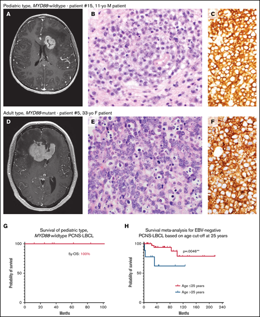 Pediatric MYD88-wildtype PCNS-LBCL is associated with favorable clinical outcomes compared with its adult-type counterpart. (A-F) Representative radiologic and histopathologic findings in pediatric- and adult-type PCNS-LBCL. Preoperative T1-weighted postcontrast magnetic resonance images of patients with pediatric type, MYD88-wildtype (A) or adult type, MYD88-mutant (D) PCNS-LBCL, showing overlapping radiologic features, including intraparenchymal mass lesions with diffuse enhancement and significant edema in the adjacent white matter. Histologic analysis showed sheets of malignant large B-cells diffusely expressing CD20. Hematoxylin and eosin, magnification ×400 (B,E); and CD20, original magnification, ×400 (C,F). (G) Kaplan-Meier survival plot of 7 patients with pediatric type, MYD88-wildtype PCNS-LBCL. (H) Kaplan-Meier meta-analysis of 53 pediatric and young-adult patients with PCNS-LBCL stratified by age ≤ 25 years vs 26 to 40 years.